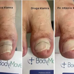 Leczenie wrastającego paznokcia: Od domu po podologa. Co wybrać?
