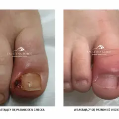 Wrastający paznokieć: Jak rozpoznać objawy i kiedy do podologa?