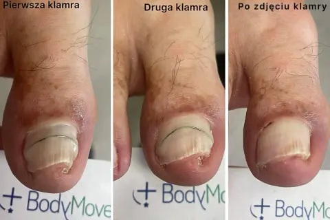 Leczenie wrastającego paznokcia: Od domu po podologa. Co wybrać?
